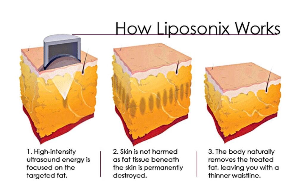 liposonix skin infographic